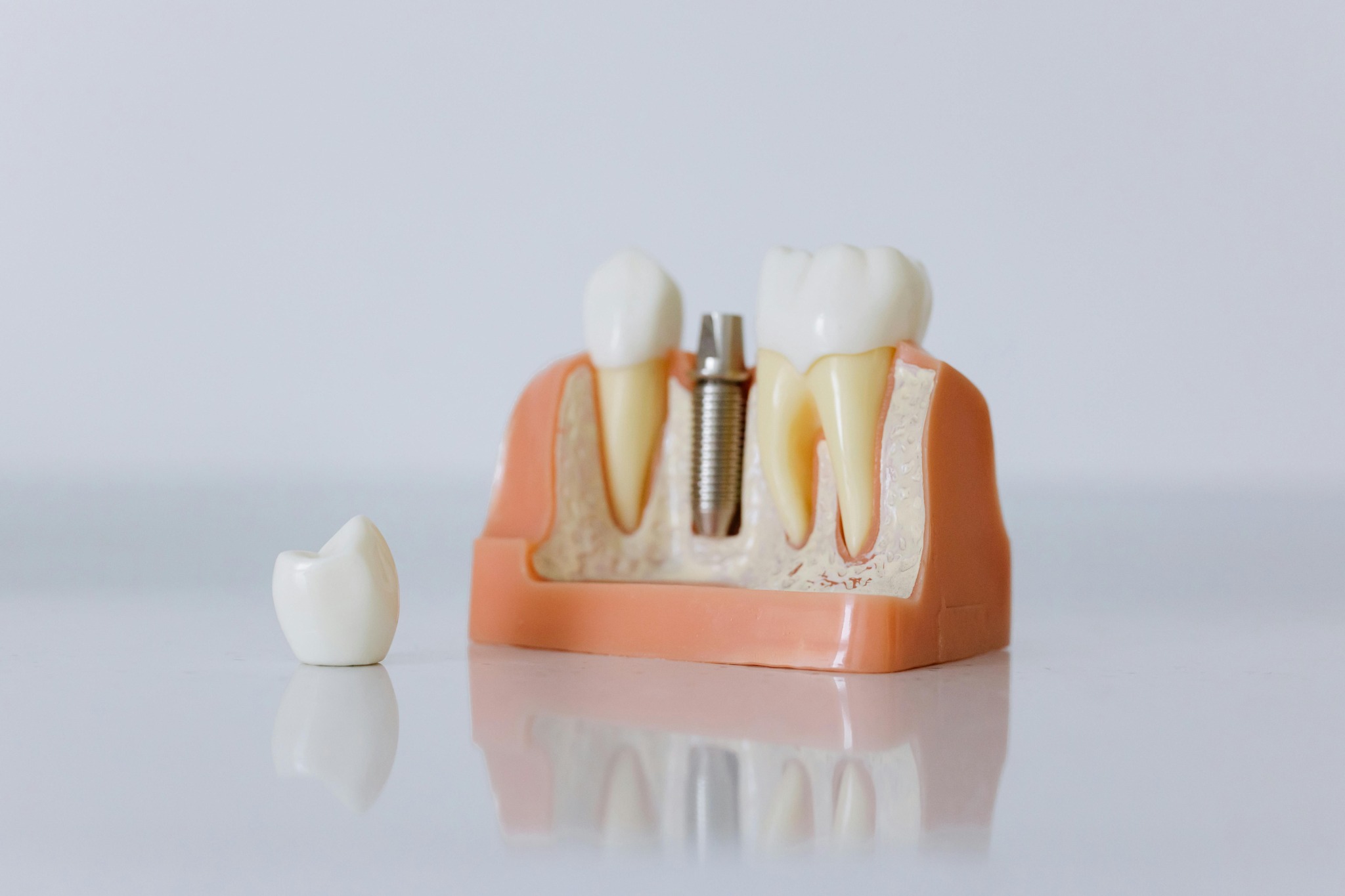 Dental implant model with crown and natural tooth comparison